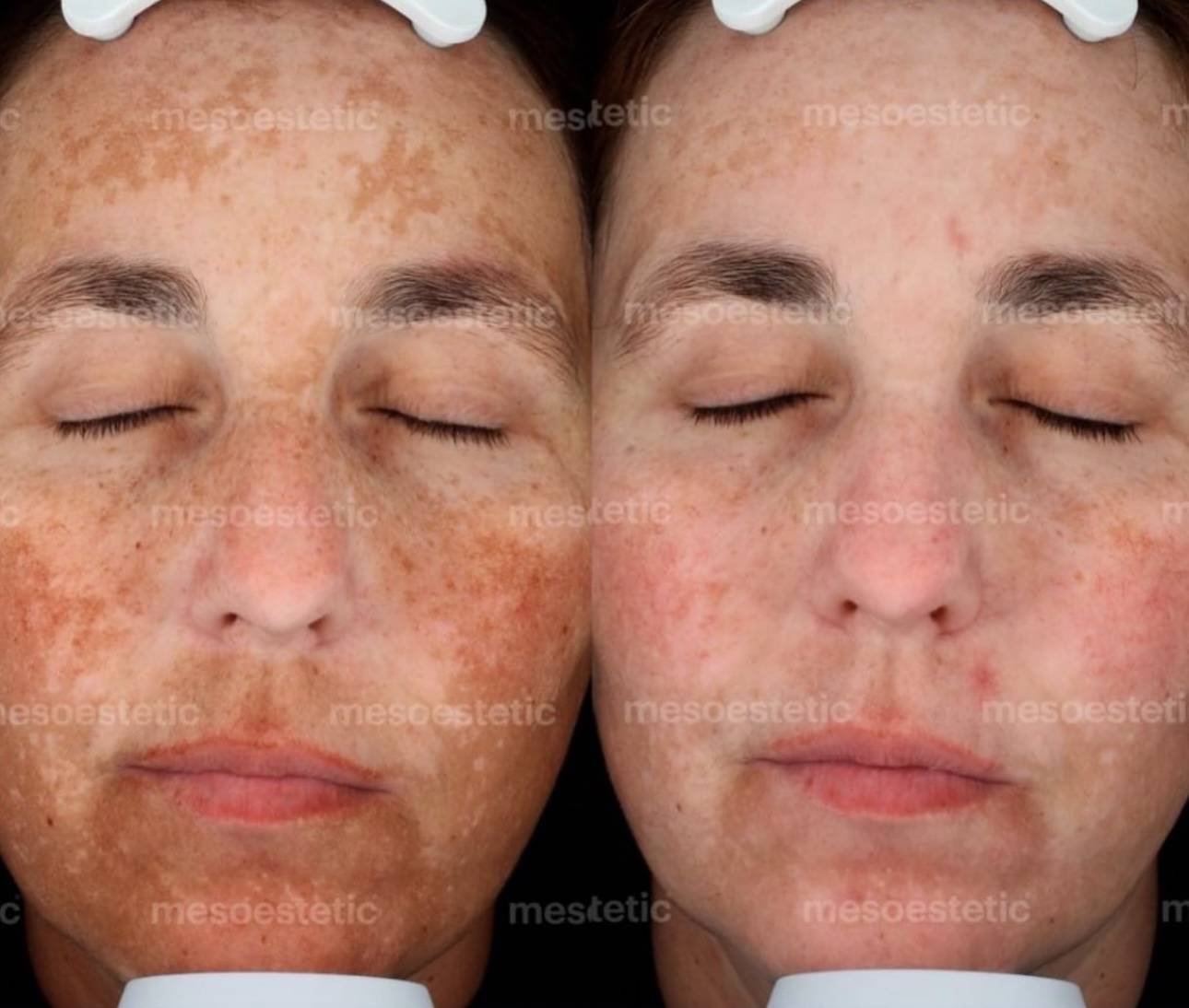 Before and after comparison of a facial treatment. The left side shows a face with significant hyperpigmentation and freckles, and the right side shows the same face with noticeably reduced discoloration after