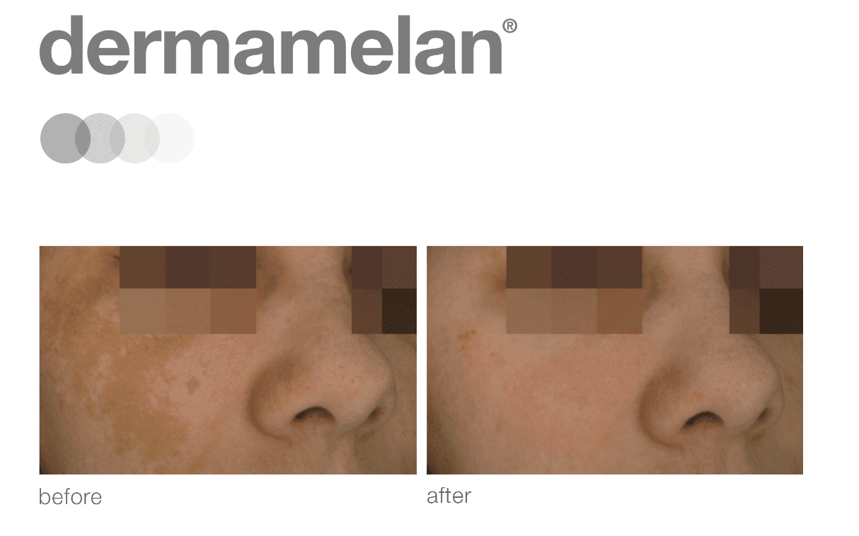 Split image titled "dermamelan" showing a close-up of a person's nose and cheek area before and after melasma treatment. The 'after' photo shows reduced redness and pigmentation