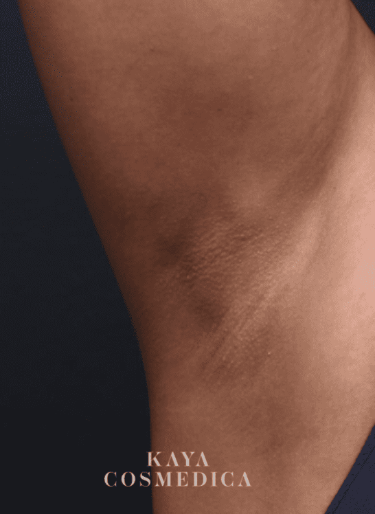 Close-up view of a person's elbow showing skin with dark patches and smooth areas, indicating intimate lightening, against a dark blue background. Text "kaya cosmedica" is visible