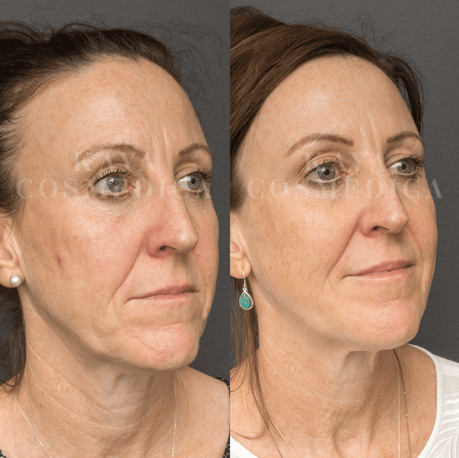 Before and after side-by-side portraits of a middle-aged woman showcasing skincare enhancements, including collagen production, with clearer skin and reduced wrinkles in the after photo. Both images are set against a grey background.