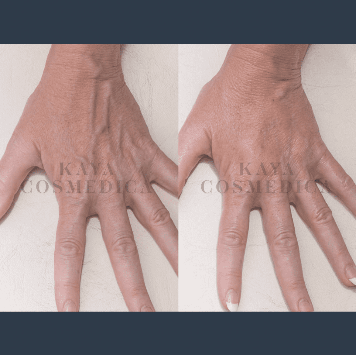 Before and after comparison of a hand treatment, showing reduced wrinkles and spots. The "kaya cosmedica" watermark is visible on both images, highlighting the effectiveness of collagen production.