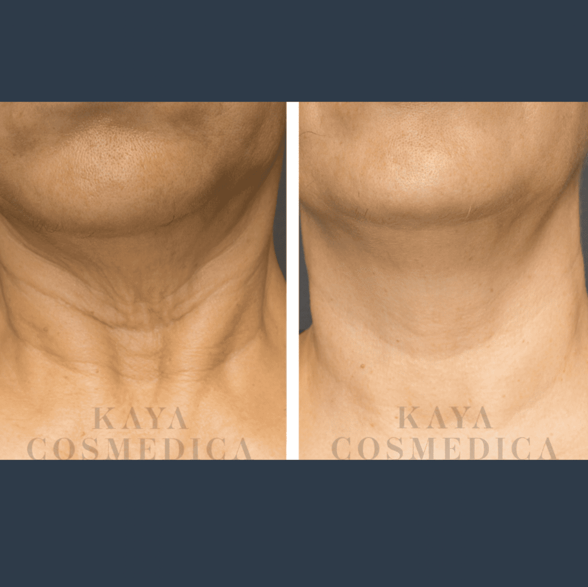 Before and after comparison images of a neck treatment from kaya cosmedica, demonstrating significant skin rejuvenation and reduction in wrinkles and skin folds.