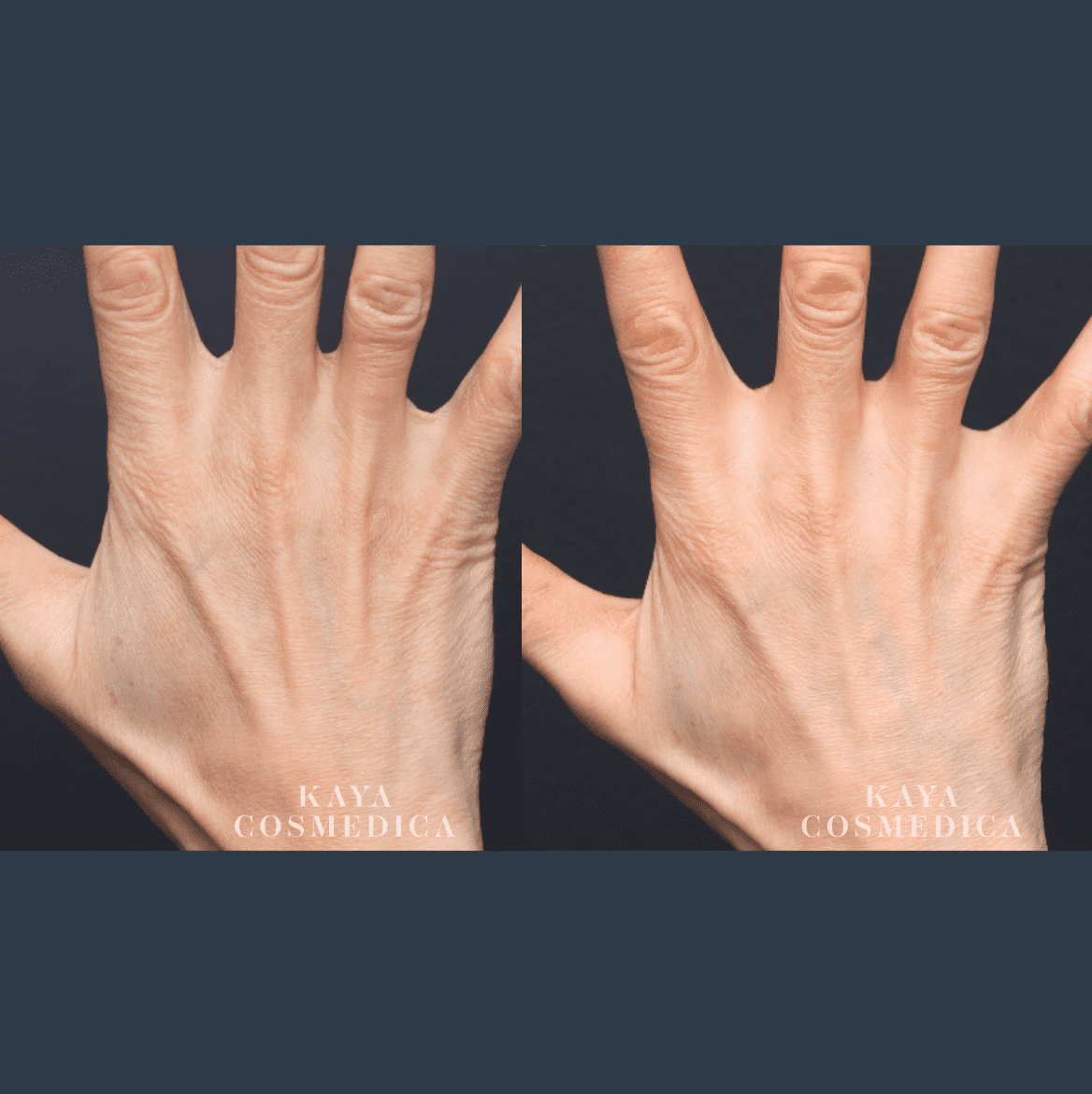 Side-by-side images comparing the dorsal view of a person’s left hand. Both images, set against a dark background, show the same hand with subtle differences in skin texture and tone due to collagen production