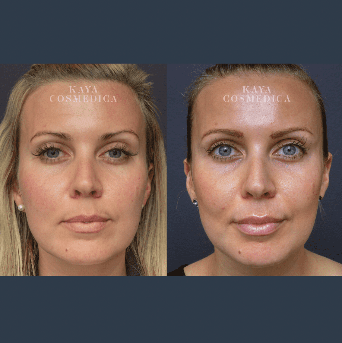 Before and after photos of a woman's face displaying dermal filler results. The left image shows her with minimal makeup, and the right image shows her with enhanced features and fuller lips.