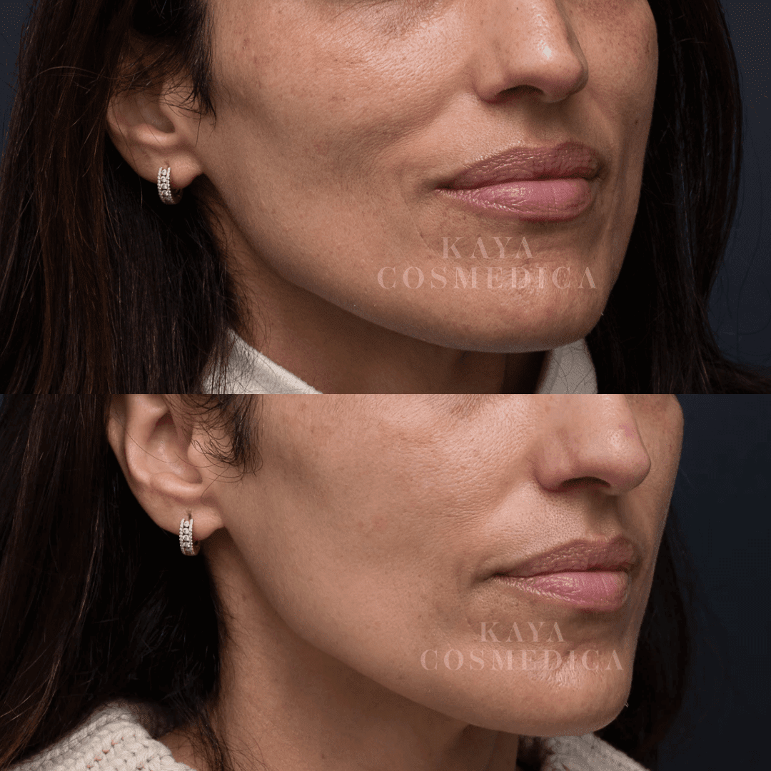 A side-by-side comparison of a woman's lower face before and after BBL therapy, focusing on improved skin texture and reduced wrinkles around her mouth.