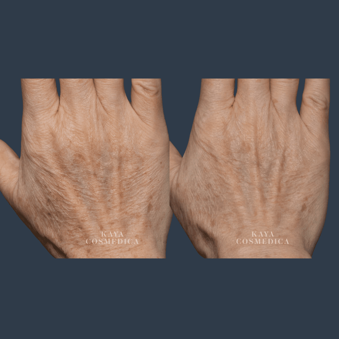 Close-up image of two aged hands against a solid blue background, showing contrasting skin textures after BroadBand Light therapy, with "kaya cosmedica" watermarked on the lower part of each image