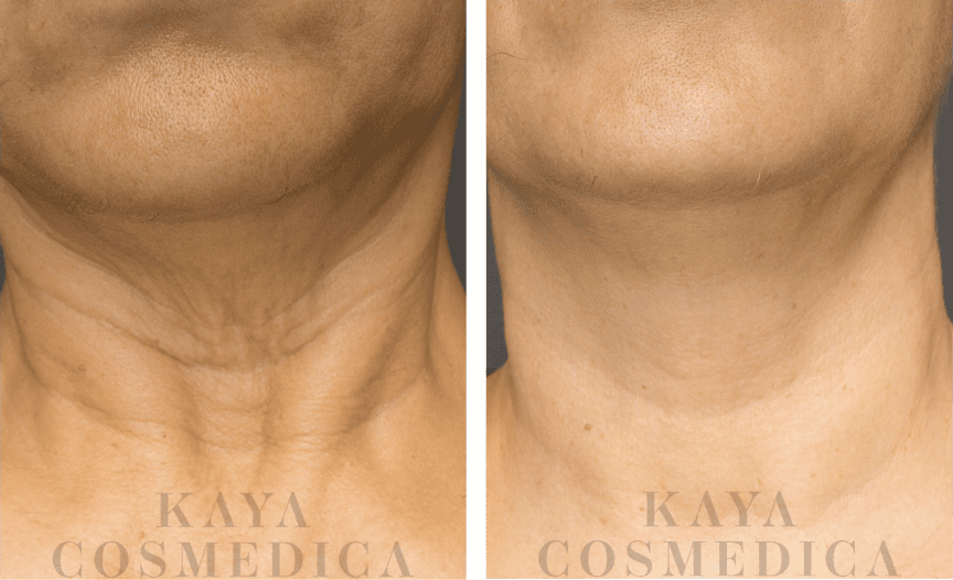 Before and after photos displaying the effects of neck rejuvenation treatment. The left side shows deep neck creases, and the right side features a smoother neck with reduced creasing. Each photo is marked with