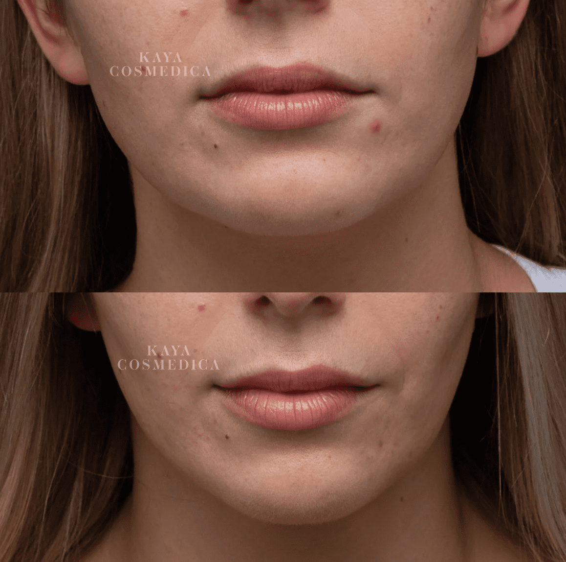 Close-up split comparison of a woman's lower face showing before and after non-surgical jawline contouring, focusing on skin texture and clarity improvements under the chin and mouth area.