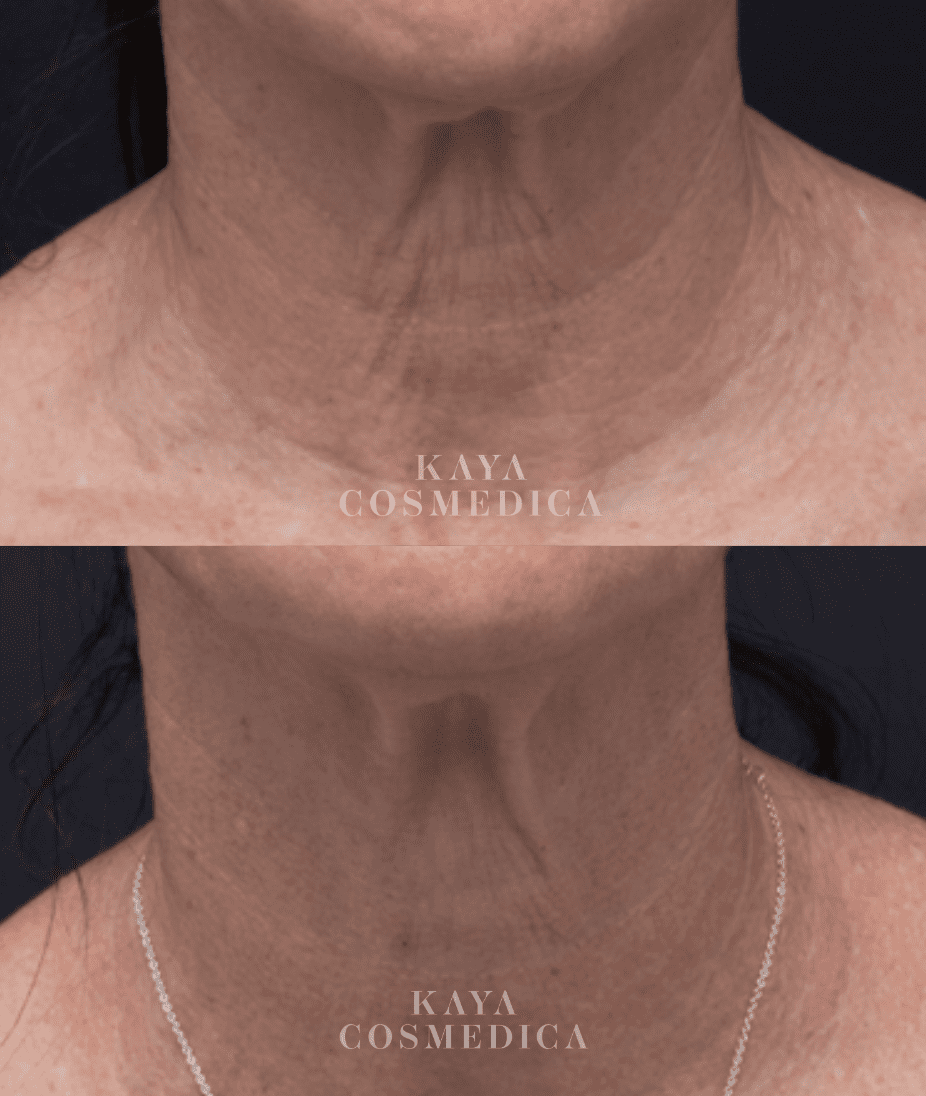 Before and after comparison of a neck rejuvenation treatment, showing visible skin care improvement and reduced wrinkles. The image includes branding text "kaya cosmedica" at the bottom.