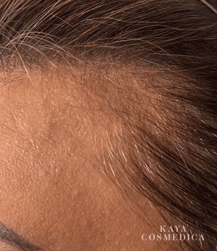 Close-up image of a person's forehead and hairline, focusing on skin texture and fine hairs as part of a baldness treatment evaluation. The skin appears smooth and is marked with a subtle watermark by
