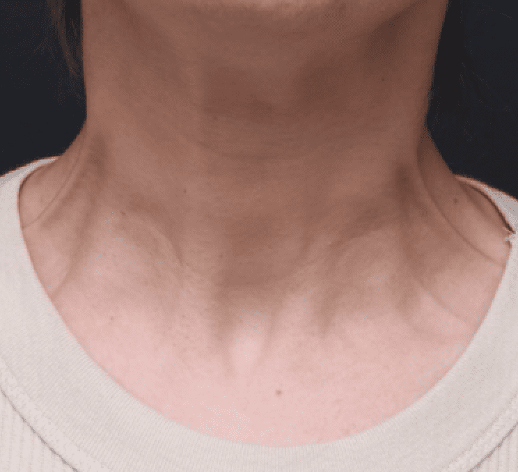 A close-up of a person's lower face and neck area, showing freckled skin and visible collarbones. The individual is wearing a pale sweater and set against a dark background. This portrait emphasises a rejuvenated decolletage area.