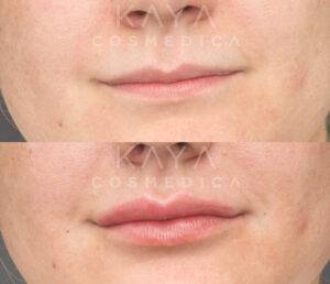 Close-up comparison of a person's lower face, before and after lip fillers, focusing on the mouth and chin areas. The image has a watermark reading "kaya cosmedica".