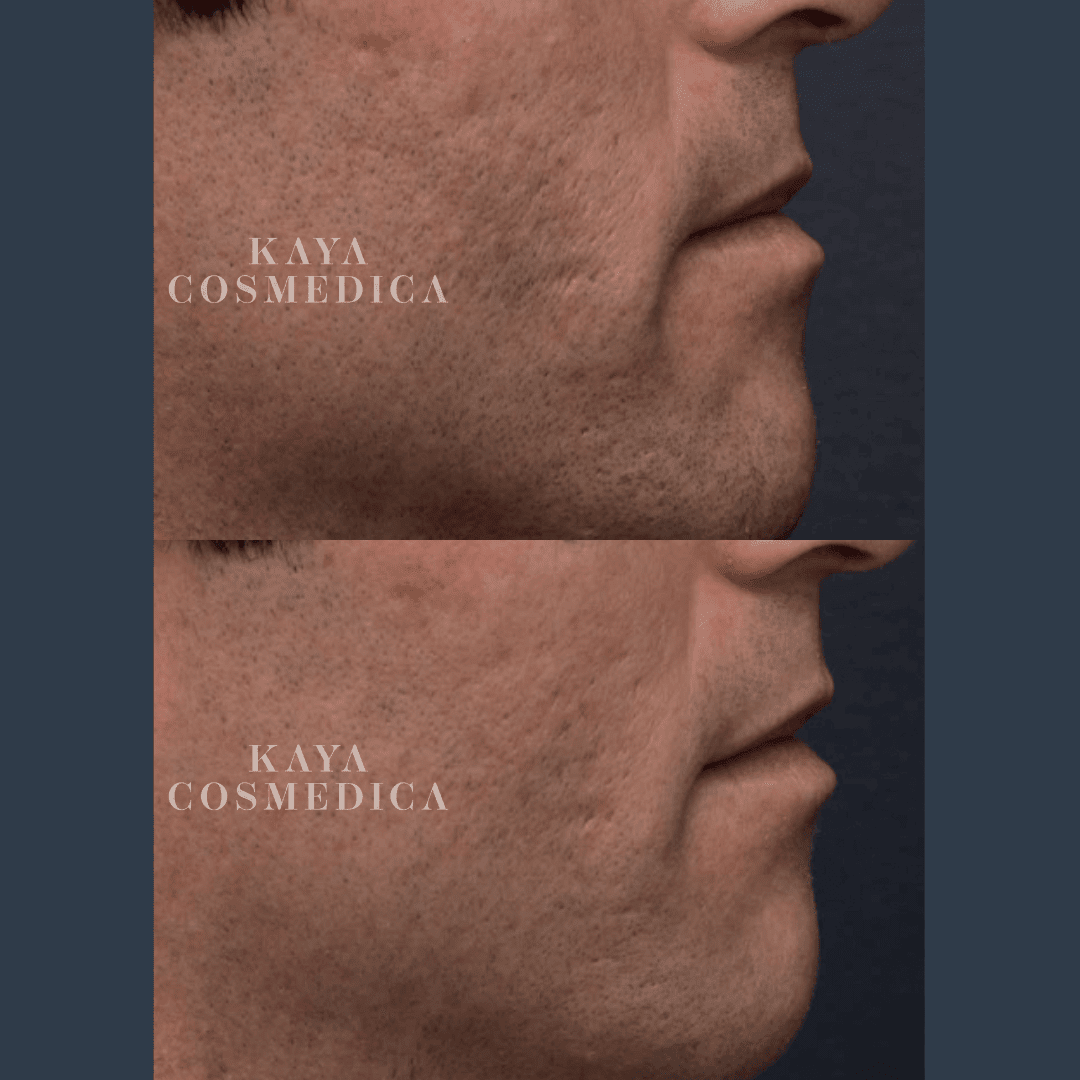 Before and after profile shots of a person’s chin and neck area, labeled "kaya cosmedica," showing subtle changes from acne treatment, possibly indicating scar removal.