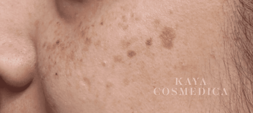 Close-up of a person's cheek showing skin with acne, blemishes, and hyperpigmentation. The visible nose corner and part of the eyebrow indicate this is a facial image. Text "k