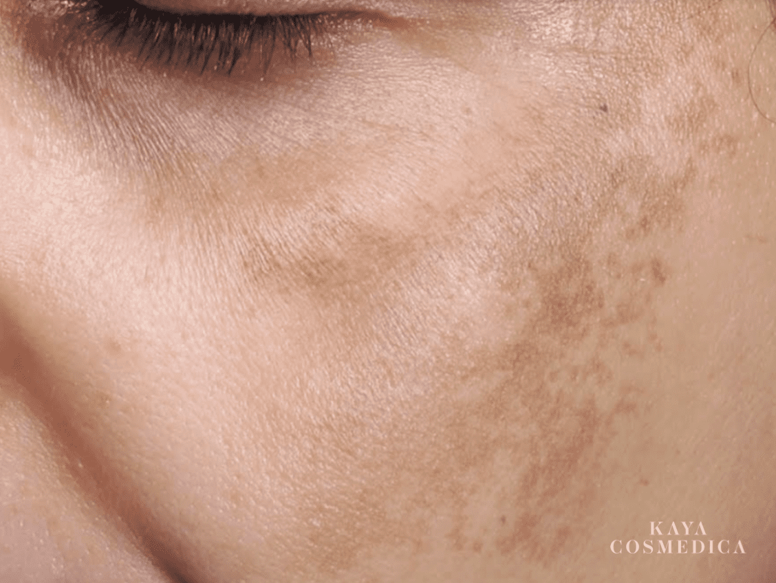 Close-up image of a person's cheek showing skin with melasma. The focus is on the hyperpigmentation issues, with natural skin texture visible. Part of the eye and eyelashes are also seen