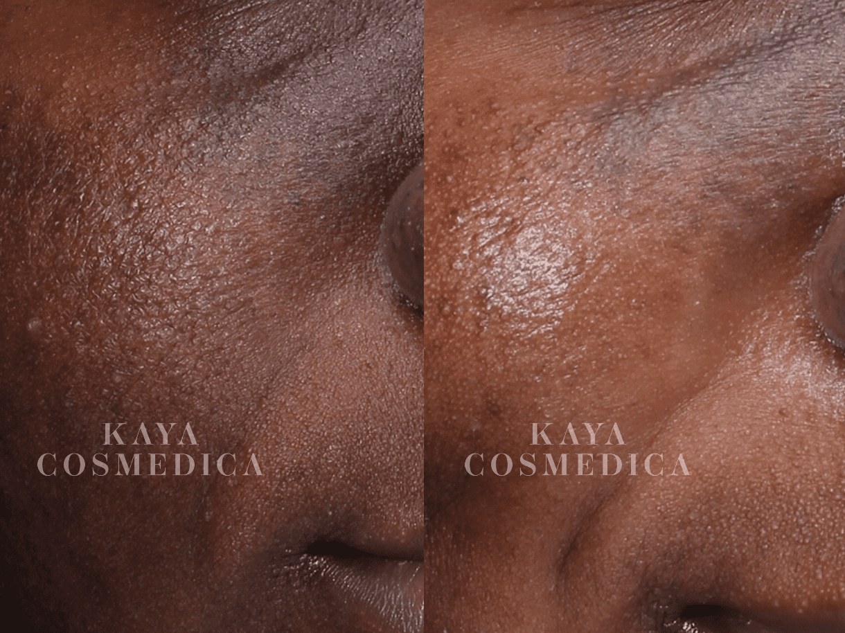 Close-up comparison of a person's skin before and after treatment, showing texture, pores, and pigmentation with "kaya cosmedica" watermark on both images.