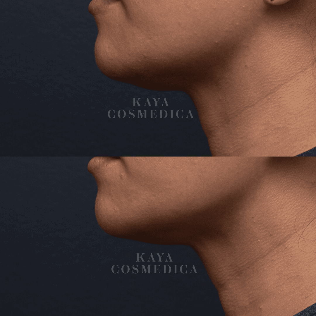 A side-by-side comparison of a person's profile before and after an Ultherapy treatment on the chin and neck area, showing a more defined jawline in the after image. Both images are set against