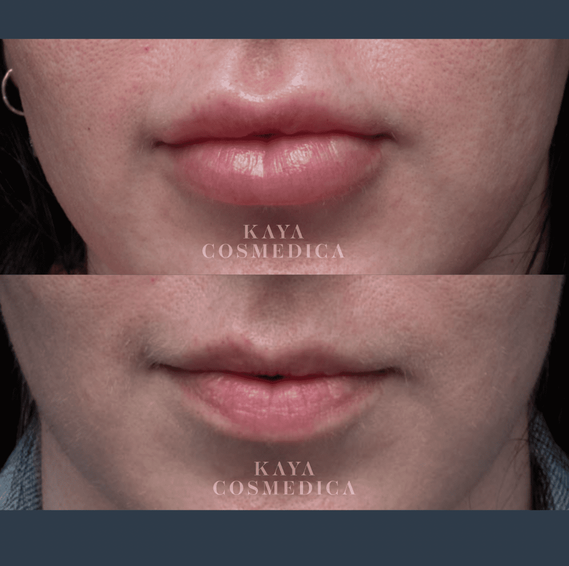 A close-up image comparing the lower half of a woman's face before and after a cosmetic lip treatment for filler dissolution, with the clinic name "kaya cosmedica" displayed.