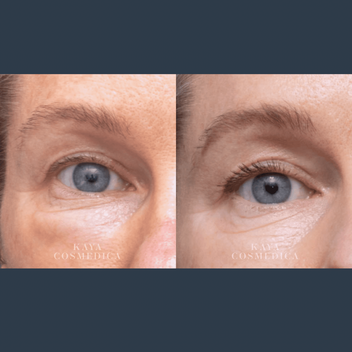 Before and after close-up images of a person's eyes showing improvement in skin texture and reduced wrinkles under the eye after dissolving filler treatment. Each image is labeled "kaya cosmedica.