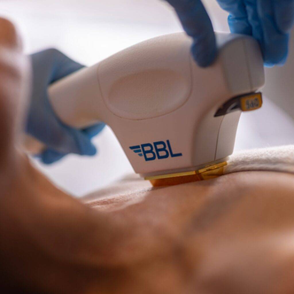 BBL Therapy to correct a sun-damaged décolletage