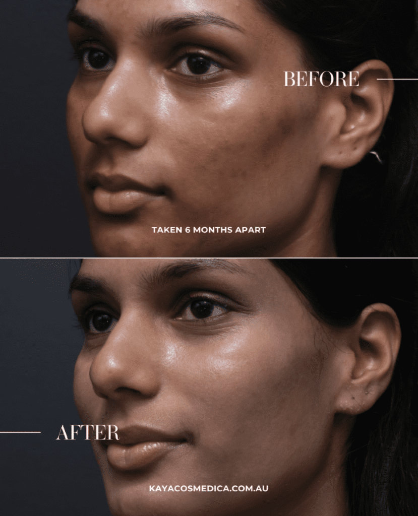 Side-by-side images of the same person's face. The top image, labeled "before," shows darker marks, while the bottom image, taken six months later after a pigmentation treatment, displays clearer skin. Text at the bottom reads "kayacosmedica.com.au".