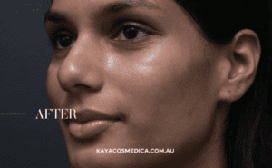 A close-up of a person's face with smooth, clear skin after a pigmentation treatment, facing left. The word "AFTER" is visible on the left side of the image, and "KAYACOSMEDICA.COM.AU" is written at the bottom. The background is plain and dark.