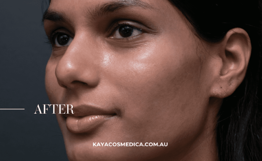 A close-up of a person's face with smooth, clear skin after a pigmentation treatment, facing left. The word "AFTER" is visible on the left side of the image, and "KAYACOSMEDICA.COM.AU" is written at the bottom. The background is plain and dark.